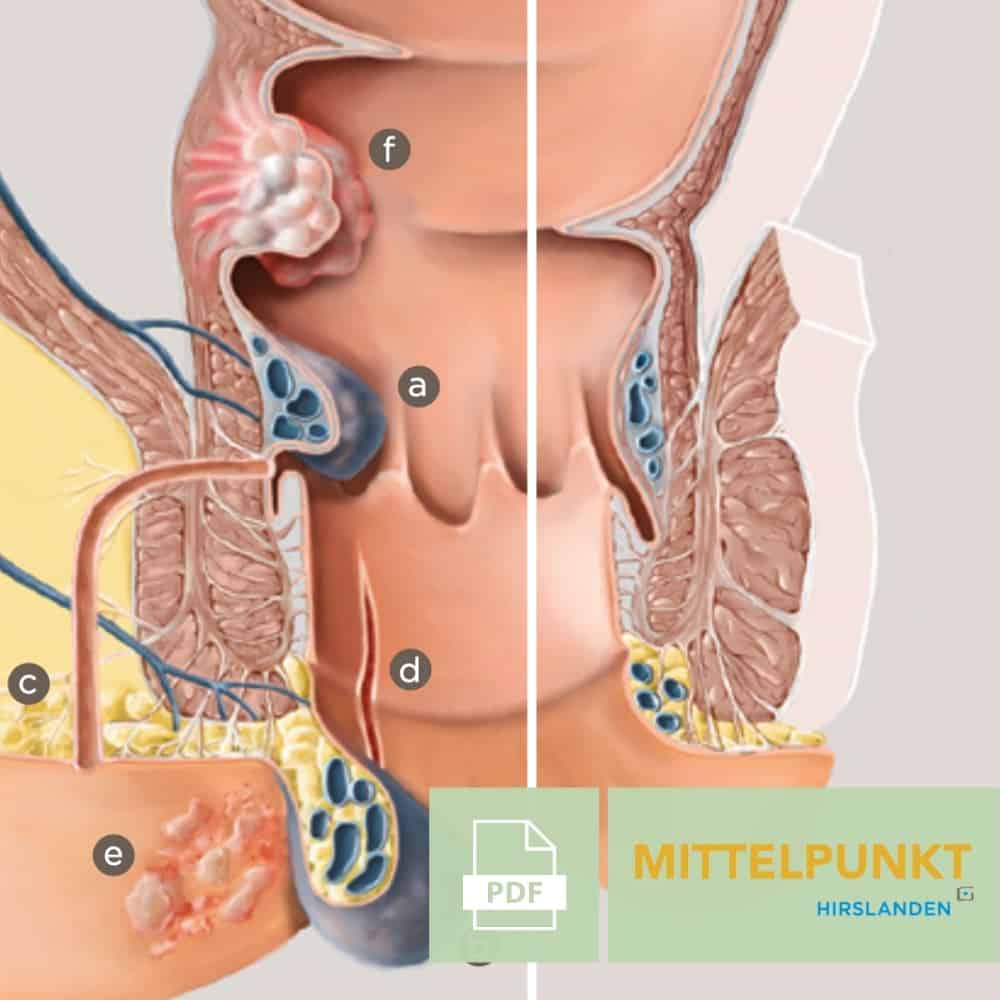 Analer Blutabgang: Ursachen und Therapien